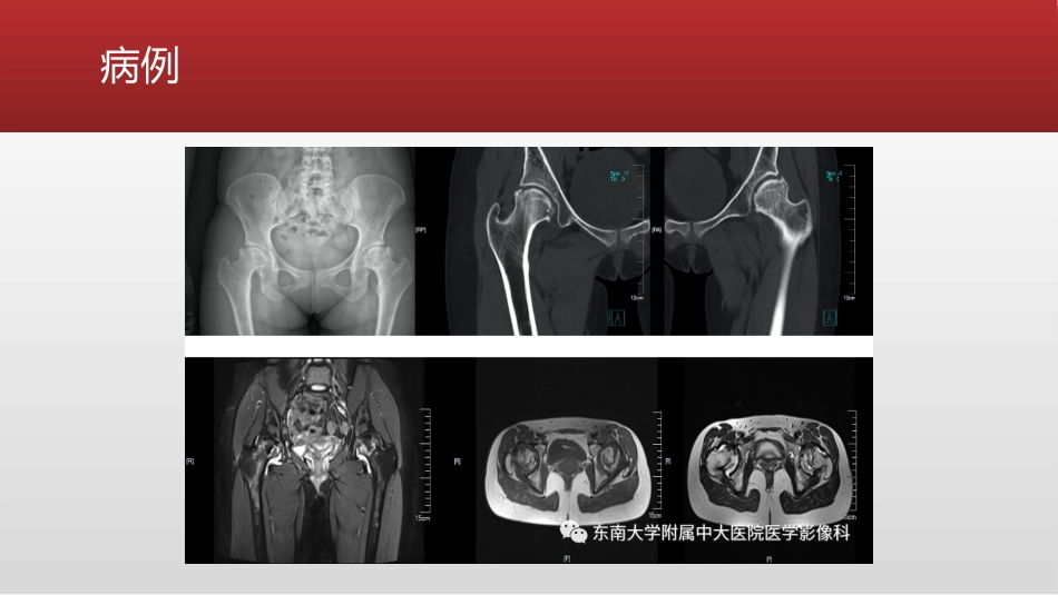 股骨头缺血性坏死影像分期和鉴别_第3页