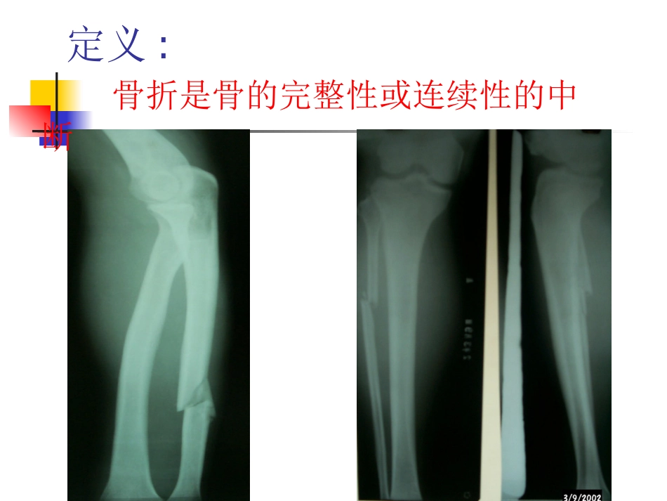 骨折的基本知识_第2页