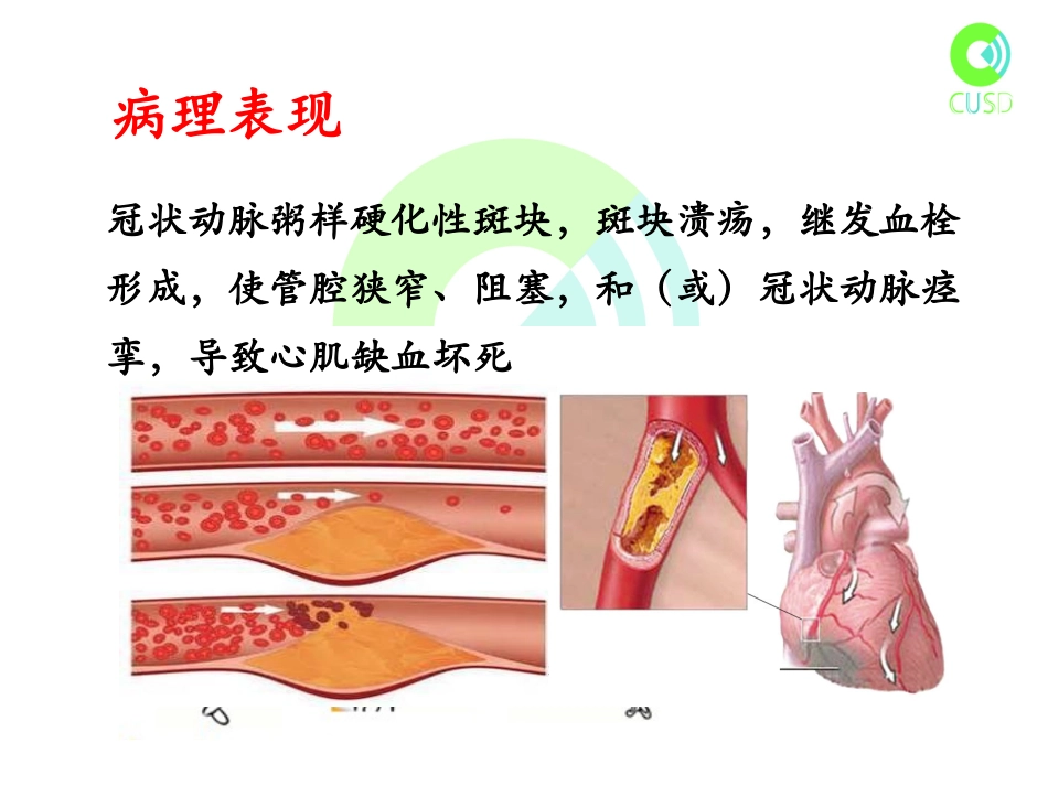 冠心病超声诊疗_第3页