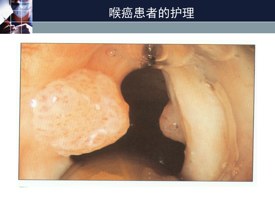 喉癌患者的护理_第1页