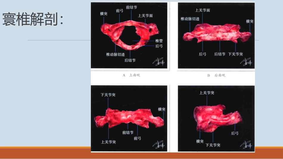 寰枢椎椎弓根螺钉技术_第2页