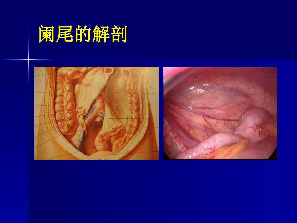 急性阑尾炎教学查房_第2页