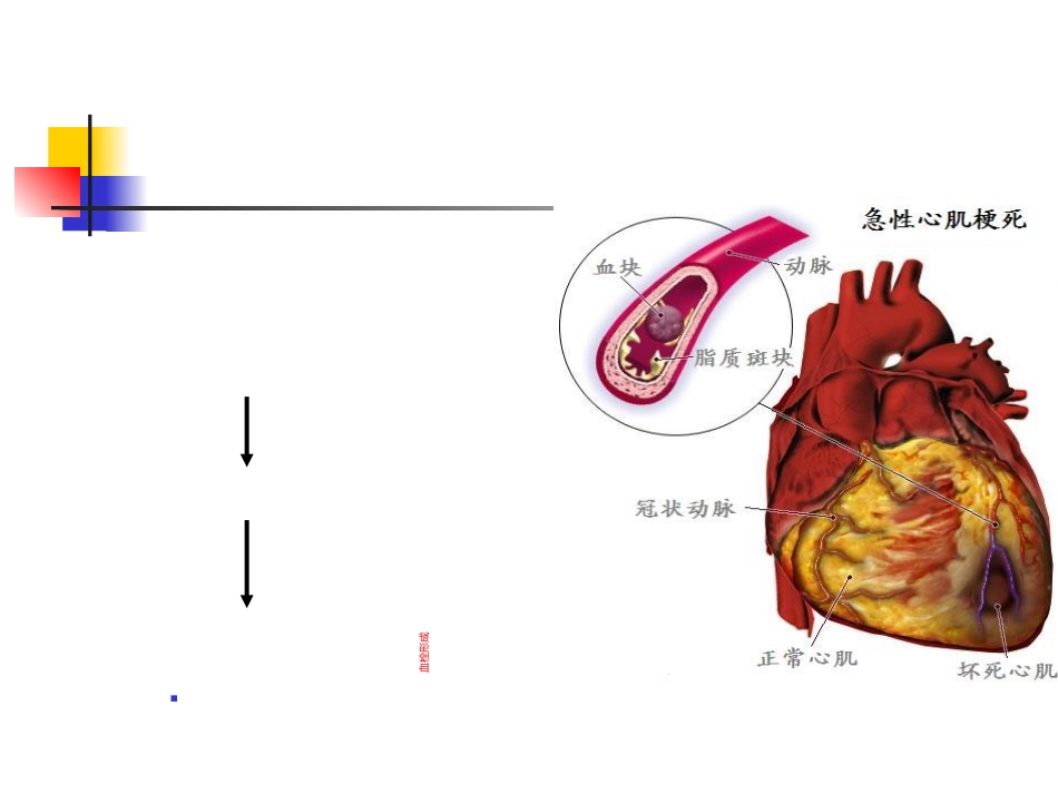 急性心肌梗死课件_第2页