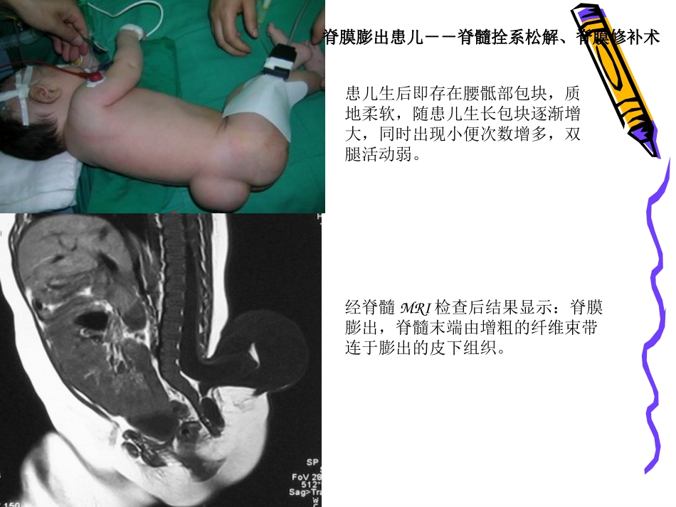 脊髓拴系综合征_第2页