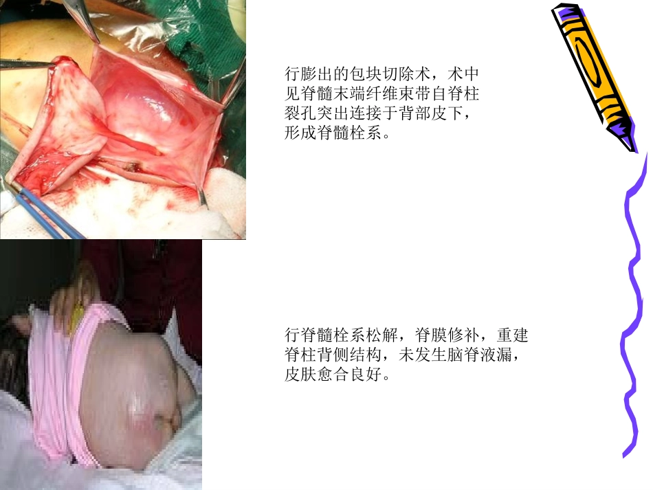 脊髓拴系综合征_第3页