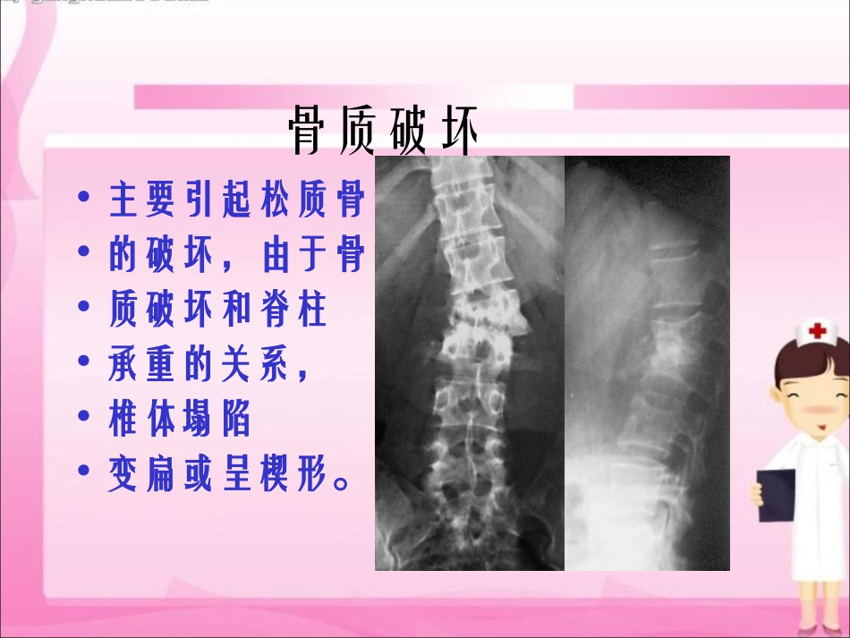 脊柱结核的疾病和护理_第3页