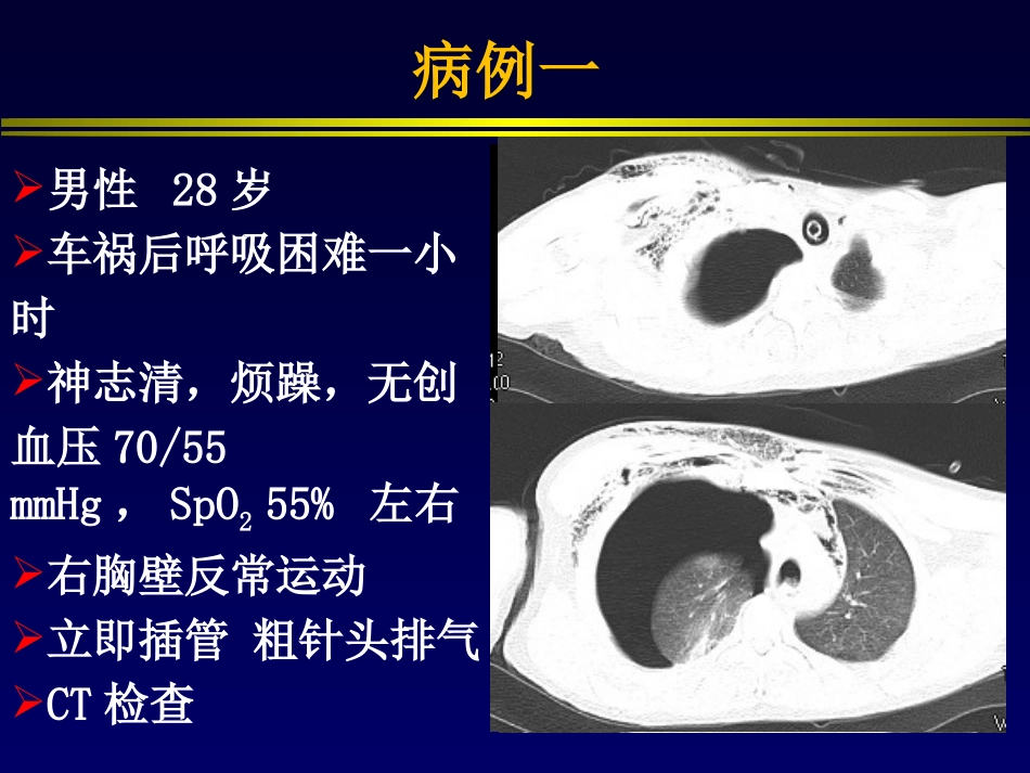 交通性气胸的机械通气_第2页
