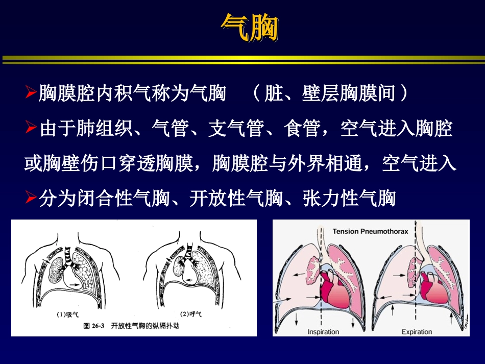 交通性气胸的机械通气_第3页