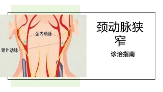 颈动脉狭窄诊治指南
