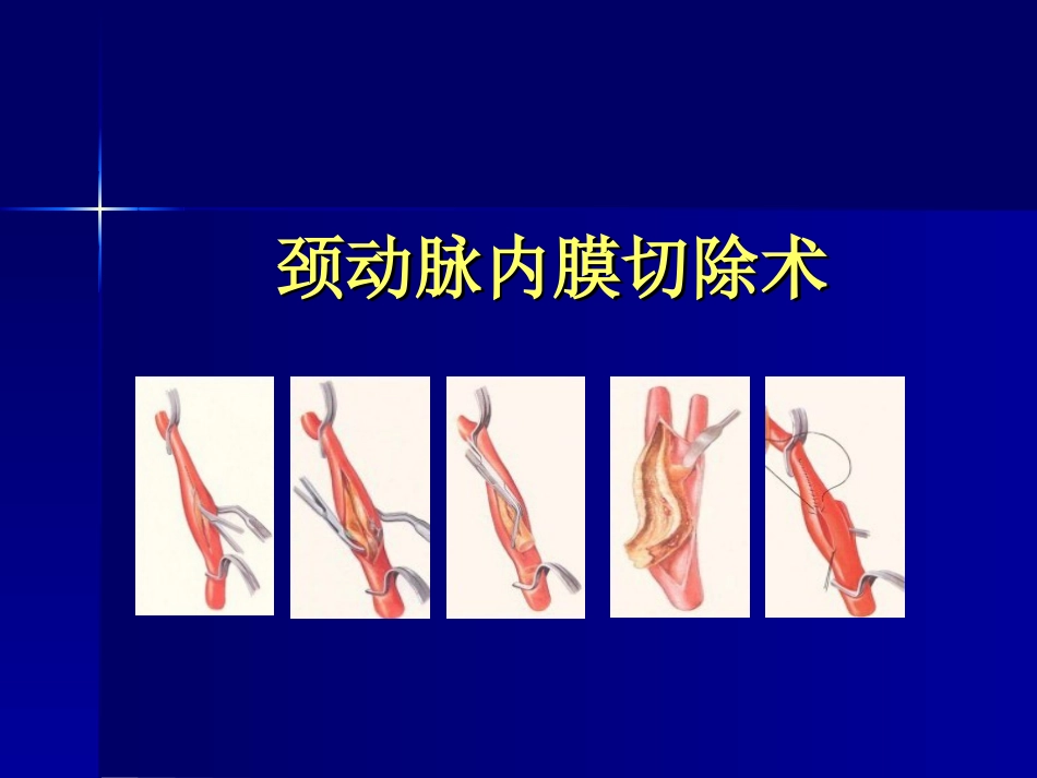 颈内动脉内膜剥脱术_第1页