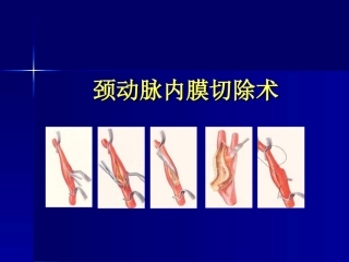 颈内动脉内膜剥脱术
