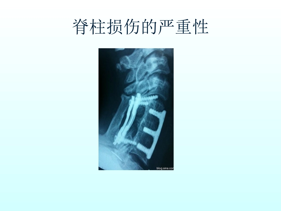 颈椎损伤固定和搬运_第3页