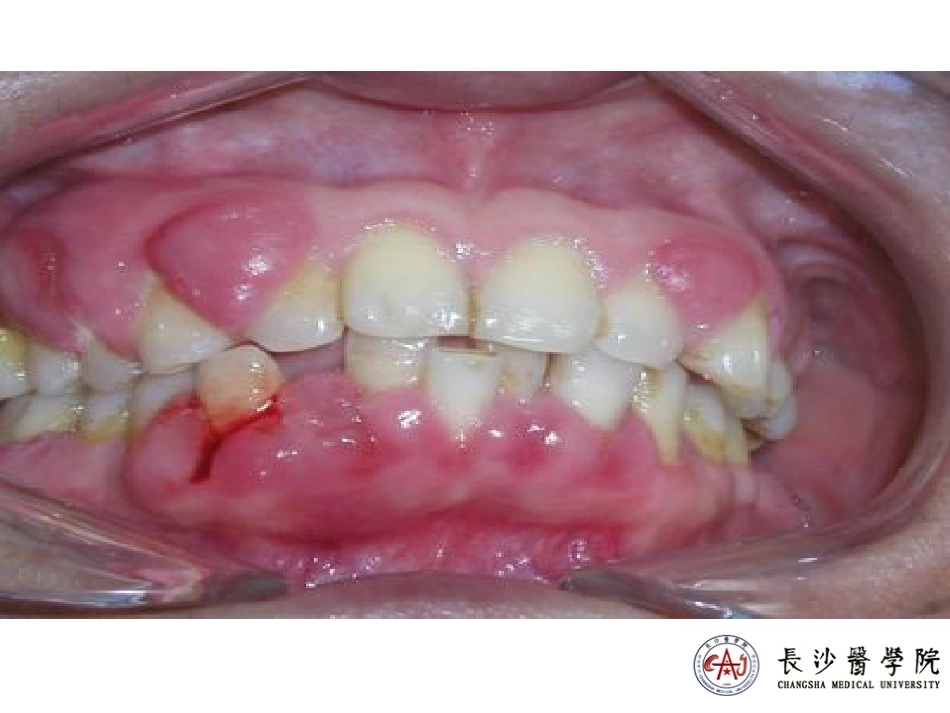 口腔组织病理牙周炎_第3页