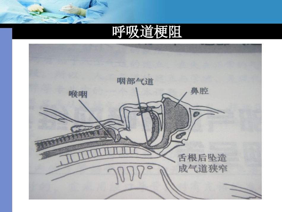 口咽通气道的使用_第3页