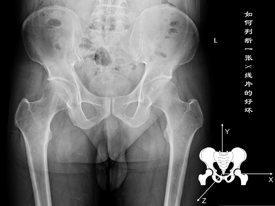 髋关节X线片测量角度_第2页