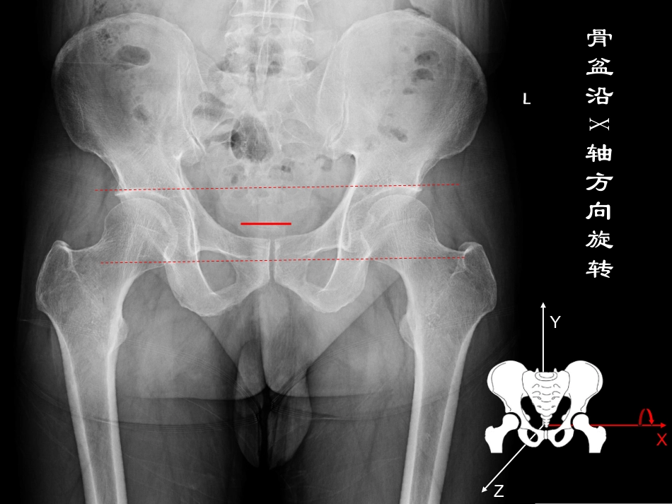 髋关节X线片测量角度_第3页