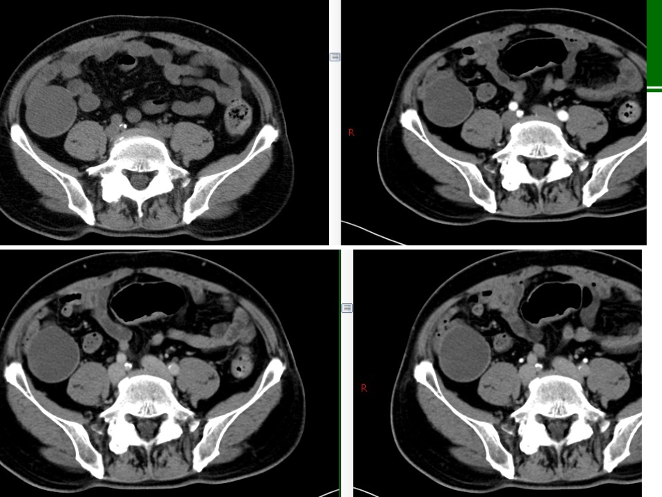 阑尾粘液性肿瘤CT诊疗_第2页
