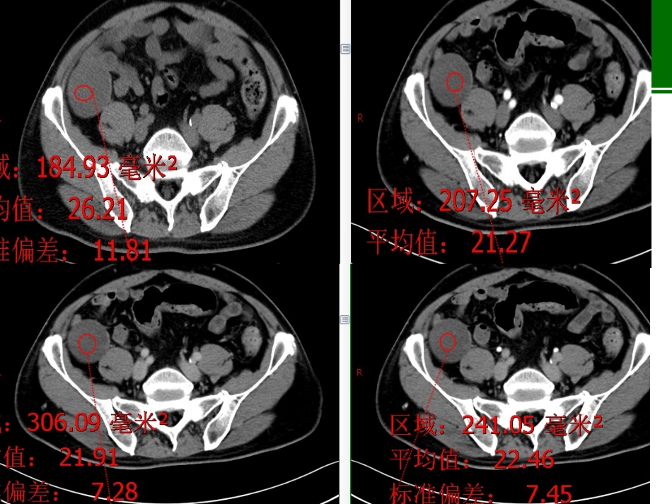 阑尾粘液性肿瘤CT诊疗_第3页