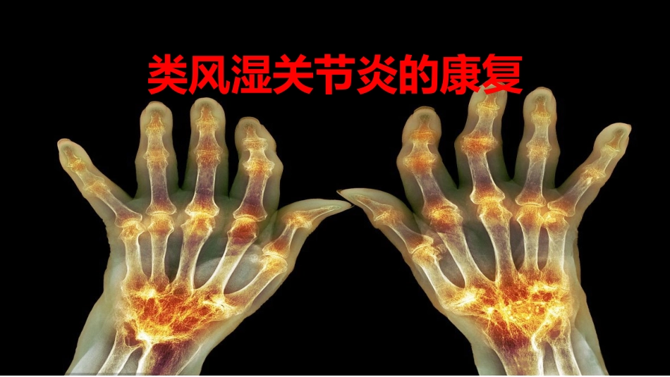 类风湿关节炎的康复_第1页