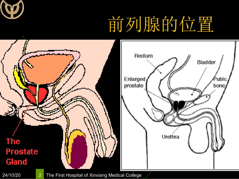 良性前列腺增生课件_第2页