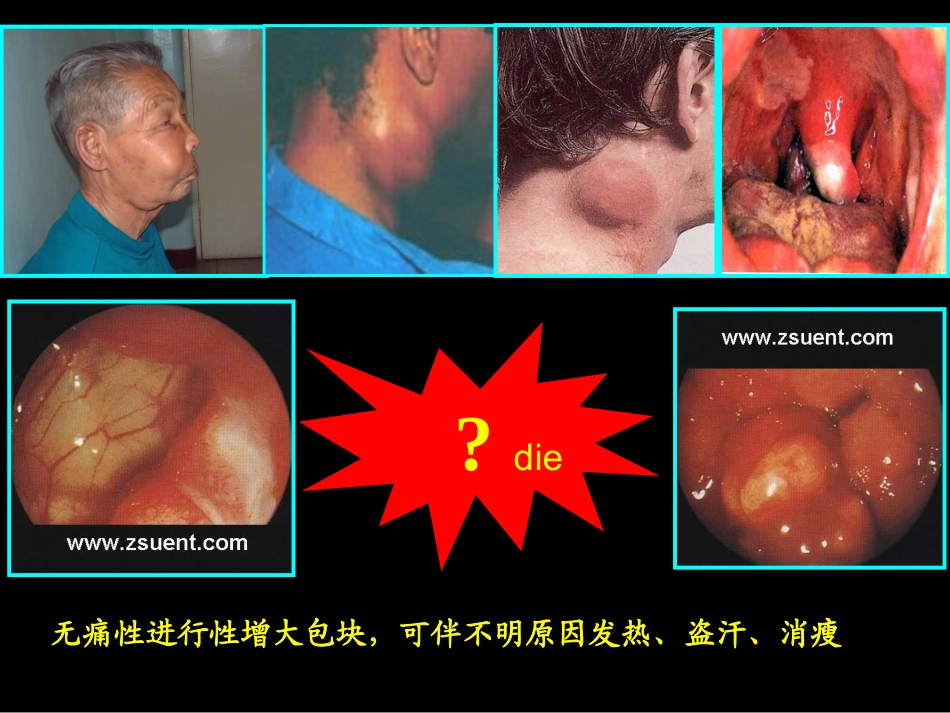 淋巴瘤病人的护理_第2页