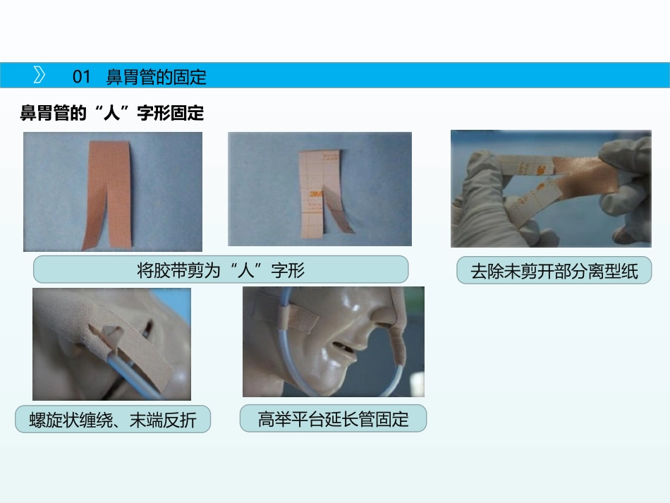 留置管道的固定_第3页
