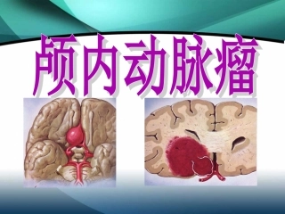 颅内动脉瘤介入术后的护理