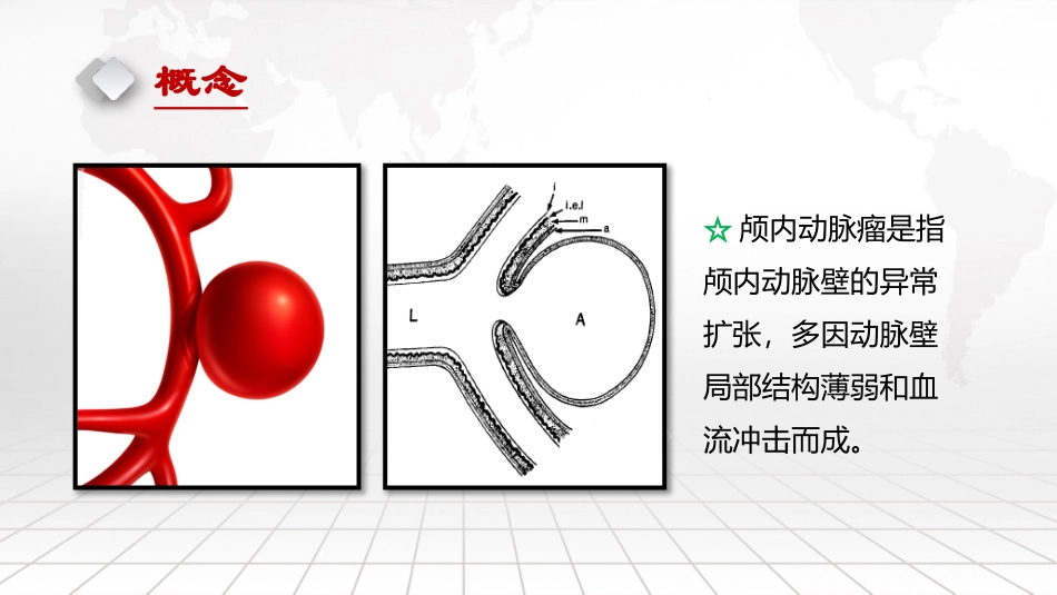 颅内动脉瘤介入诊疗及治疗_第3页