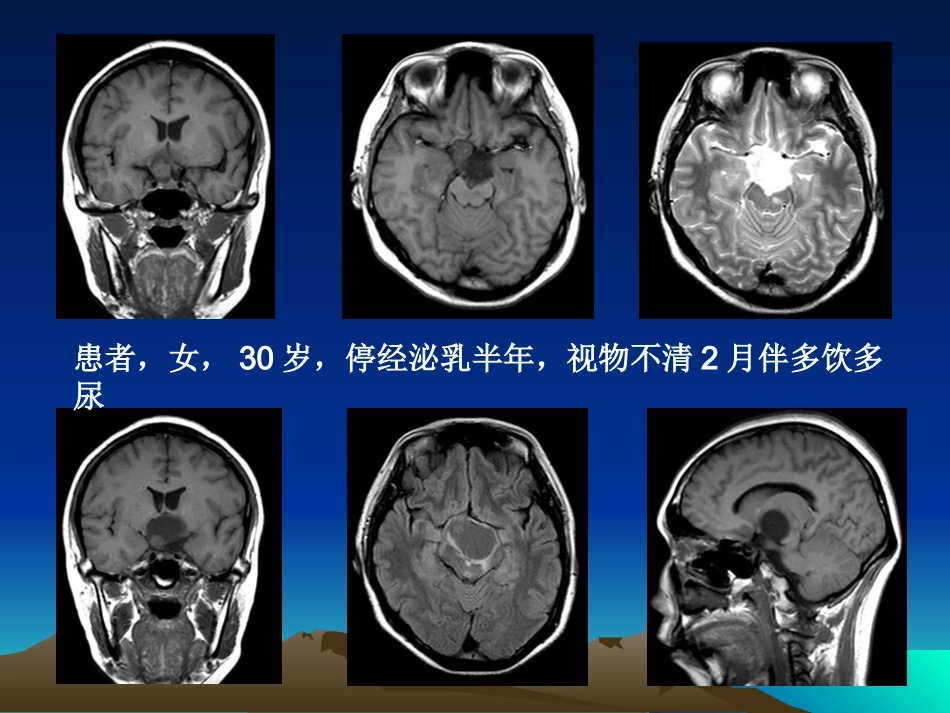 颅咽管瘤的影像诊疗_第1页