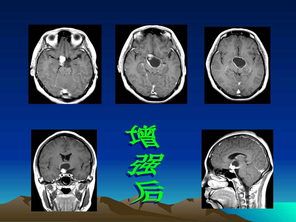 颅咽管瘤的影像诊疗_第2页