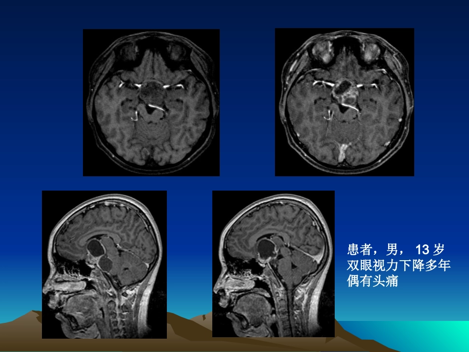 颅咽管瘤的影像诊疗_第3页