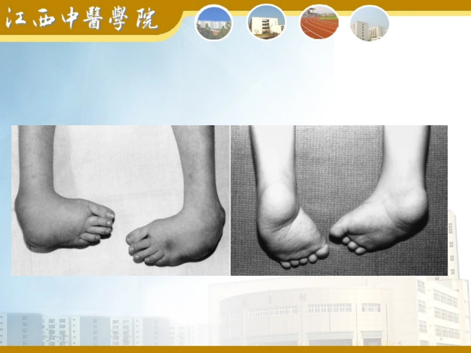 马蹄形内翻足_第2页
