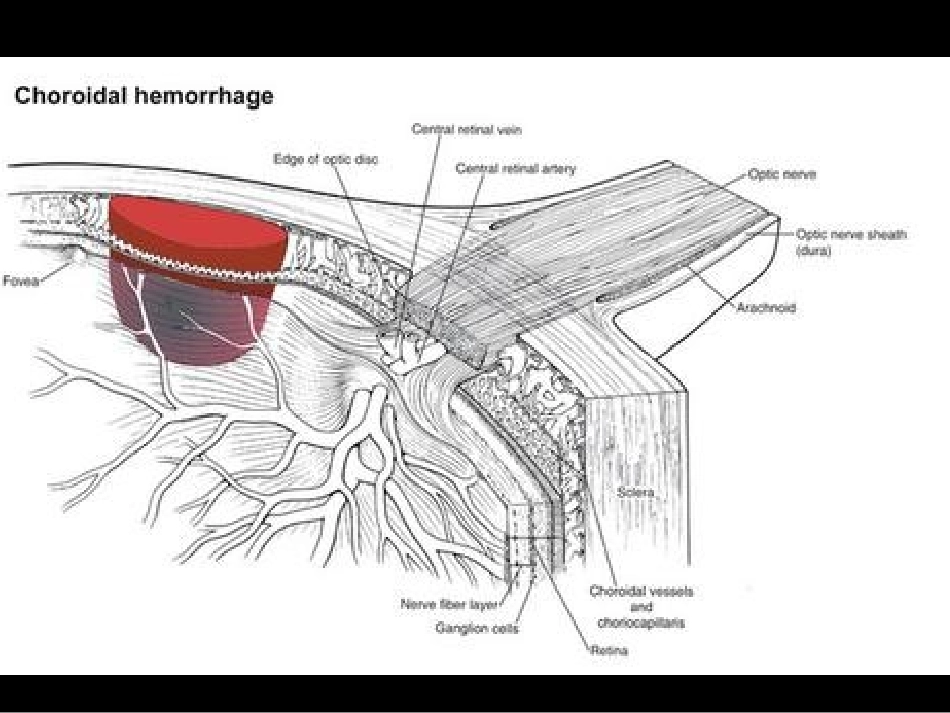 脉络膜上腔出血_第2页