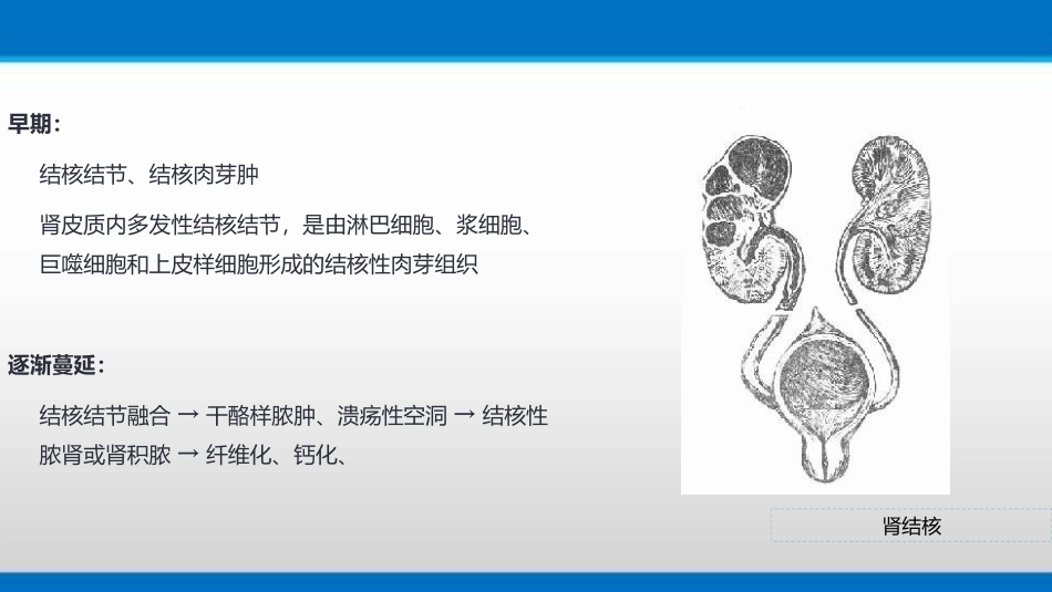 泌尿系统结核的诊疗检查和治疗_第3页