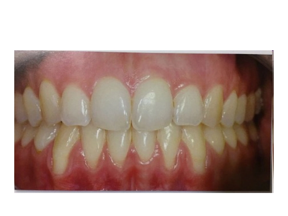 膜龈手术病例分析_第3页