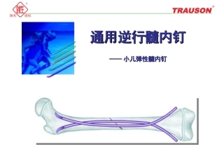 逆行髓内钉小儿弹性髓内钉资料