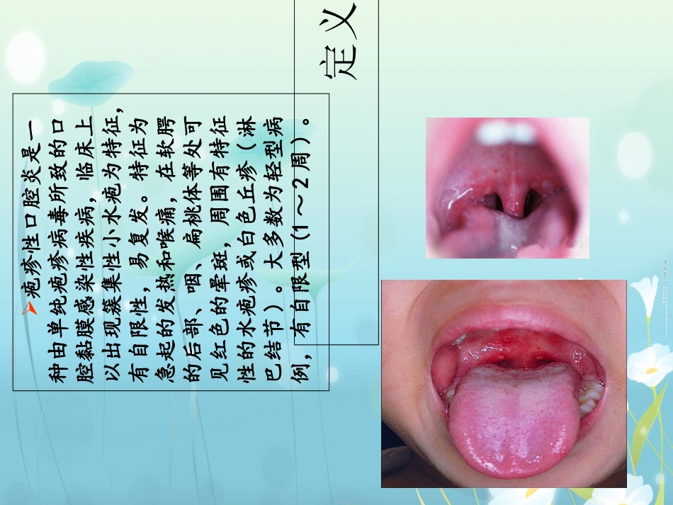 疱疹性咽峡炎-医学课件_第2页