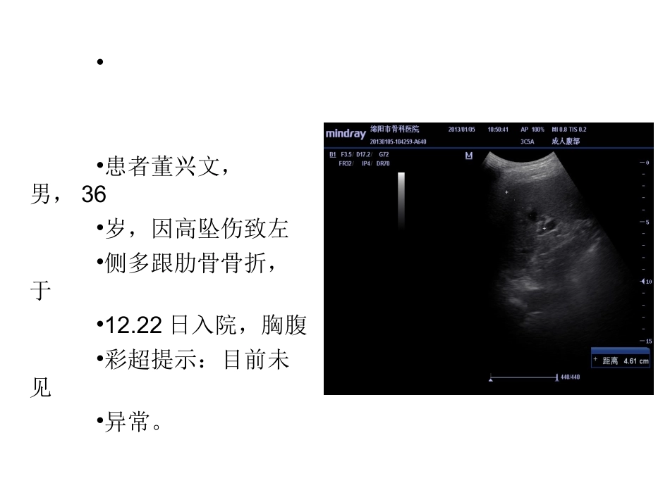 脾破裂诊断与鉴别诊断_第2页