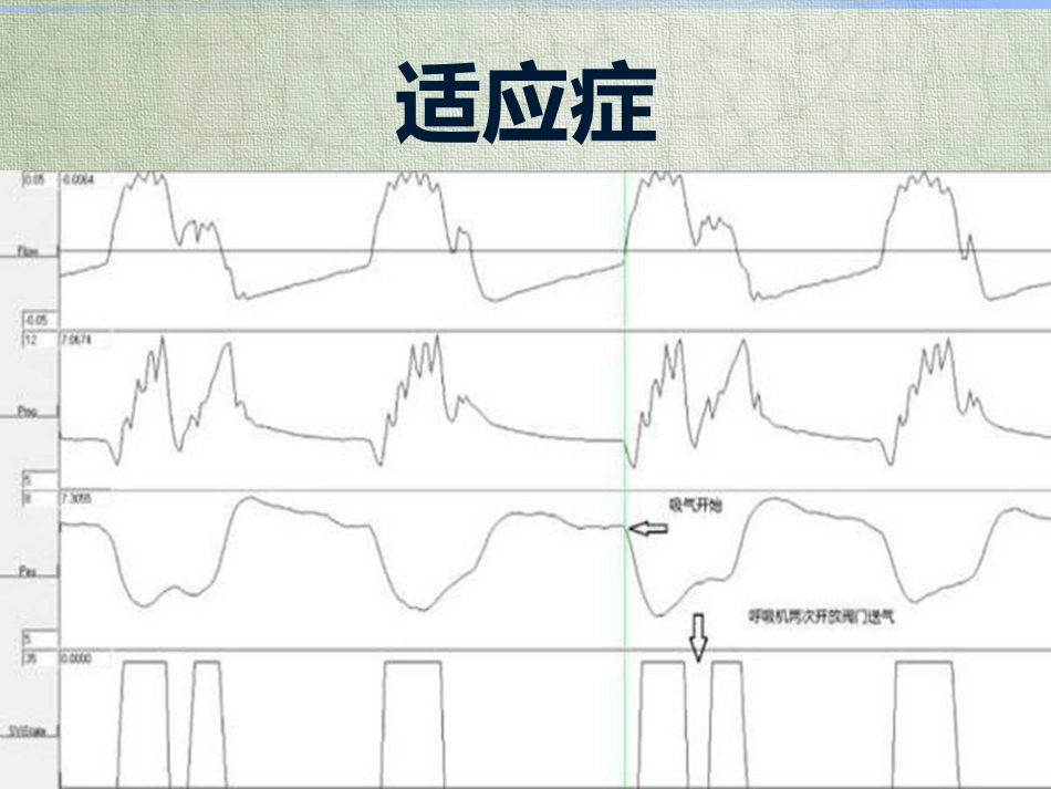 气道内分泌物吸引_第3页