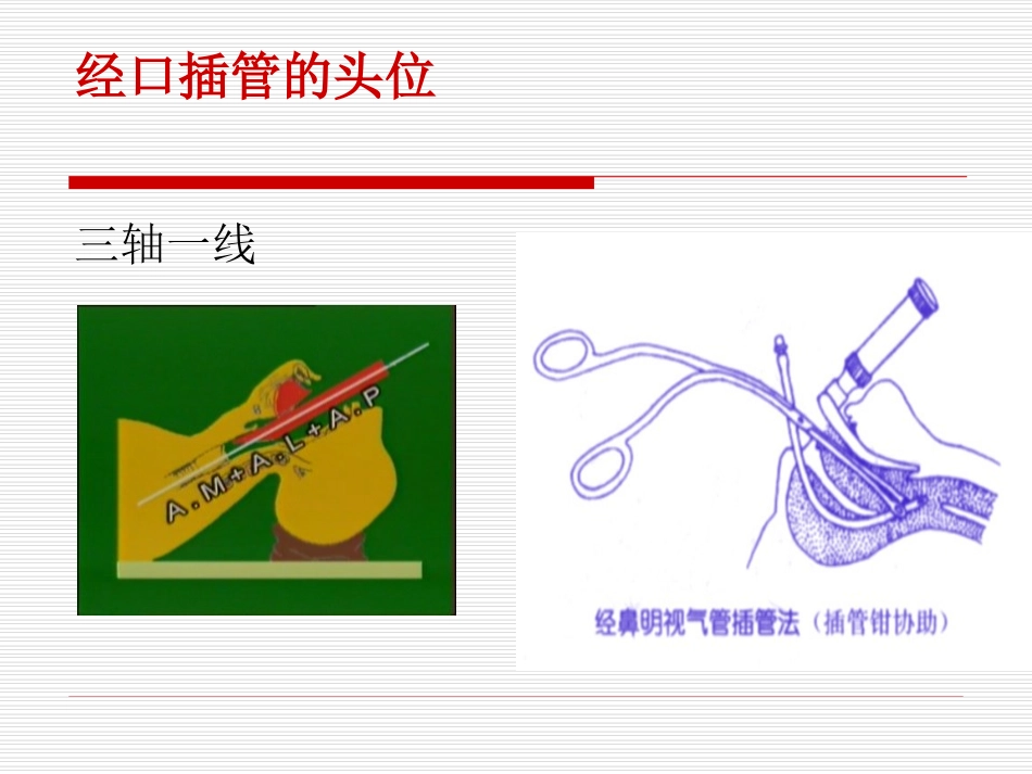 气管插管评估_第3页