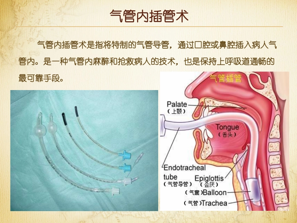 气管内插管术和气管切开术讲解_第3页