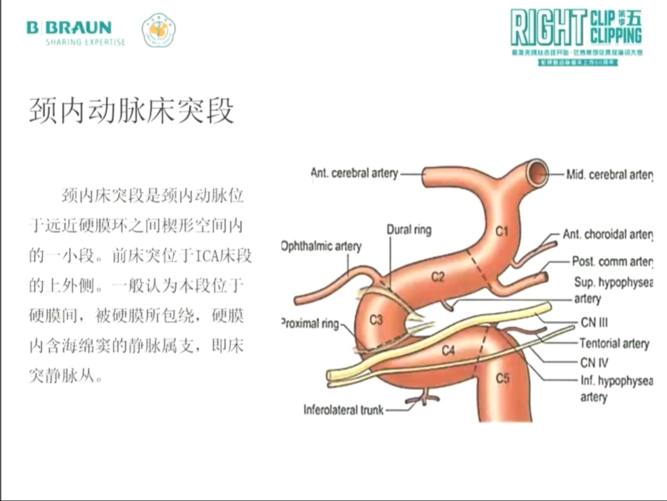 前床突巨大动脉瘤手术夹闭_第3页