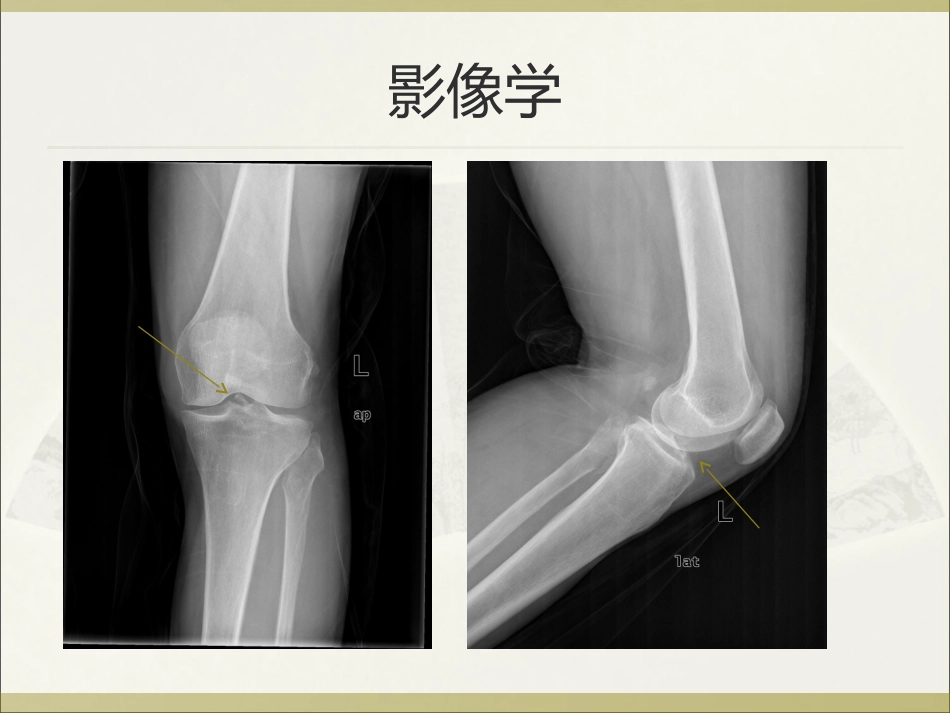 前交叉韧带胫骨止点撕脱性骨折_第3页