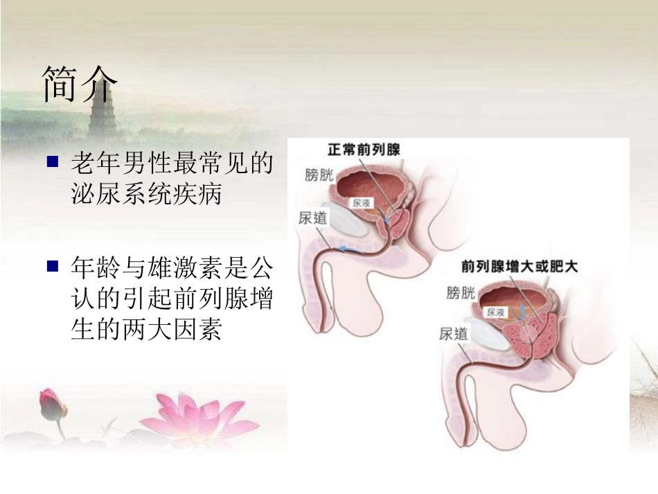 前列腺增生教学查房_第2页