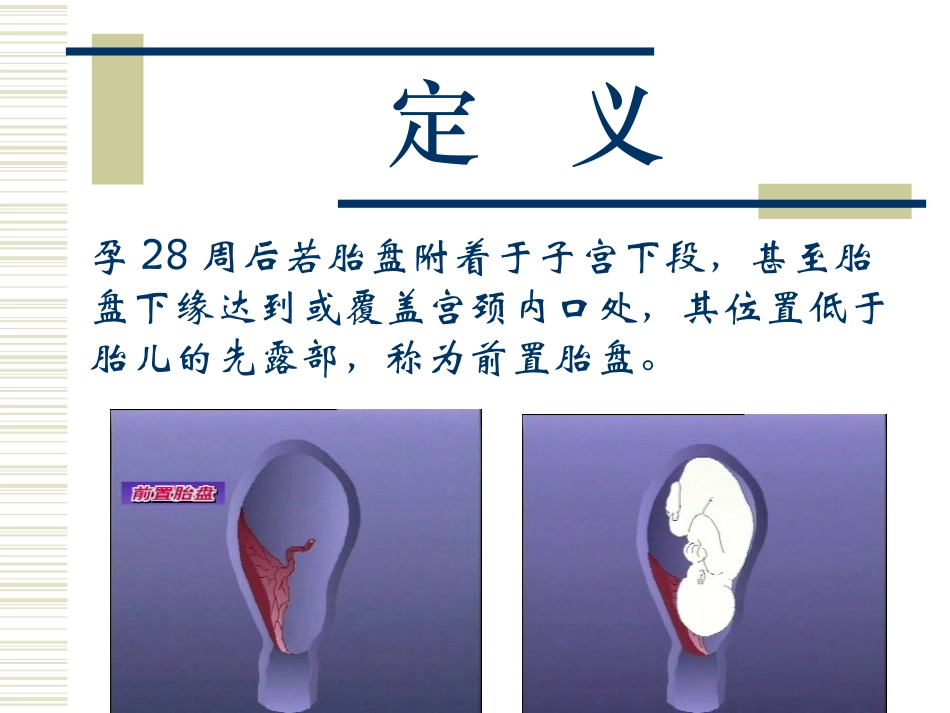 前置胎盘的护理_第3页