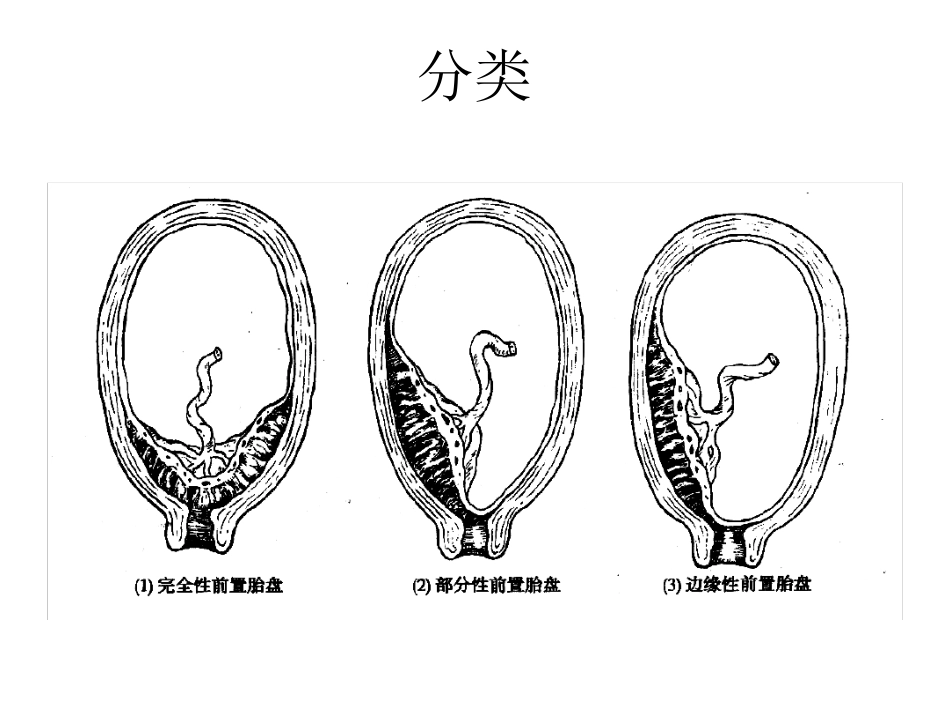 前置胎盘护理最新课件_第3页