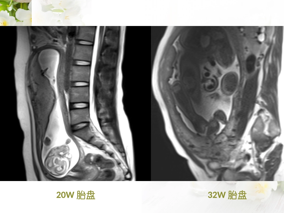 前置胎盘及胎盘植入的MRI诊疗课件_第3页