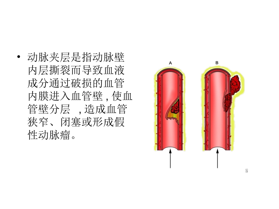 青年卒中和脑动脉夹层_第3页