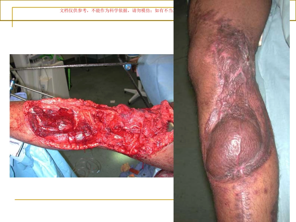 清创术和换药术课件_第3页