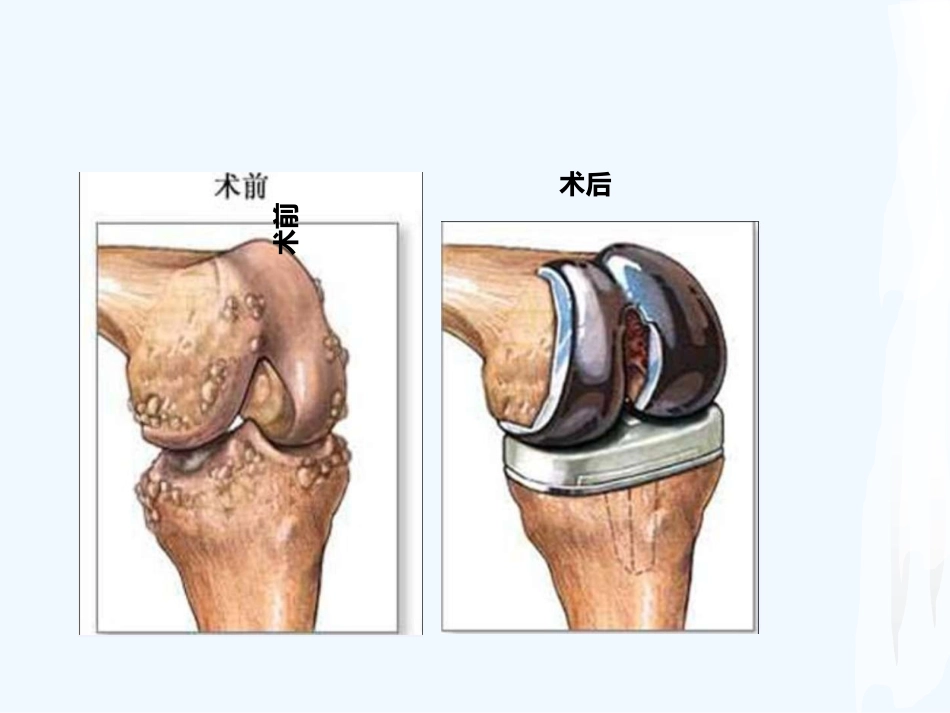 全膝关节置换术后护理课件_第3页
